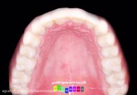 قبل و بعد از درمان ارتودنسی دندان  | دکتر محمودهاشمی متخصص ارتودنسی