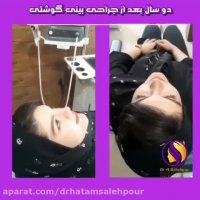 دو سال بعد از عمل بینی گوشتی