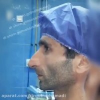 بهترین فرم بینی مردانه