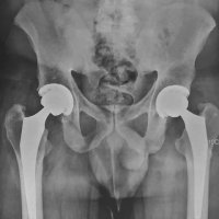 مثال هایی از جراحی تعویض مفصل ران