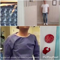 عمل جراحی تعویض كامل مفصل لگن چپ بدلیل نكروز آوسكولار سر استخوان فمور