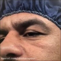 بلفاروپلاستى در آقايان