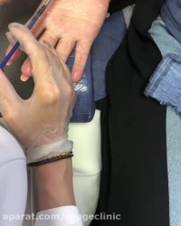 تزریق بوتاکس کف دست