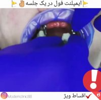 کاشت ایمپلنت یک روزه