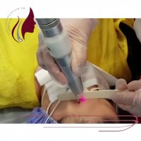 فیلم لیزر تاتوی ابرو