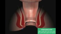 روش های درمان فیستول مقعدی با لیزر بدون بازگشت و مراقبت های بعد از عمل در کلینیک زارعی