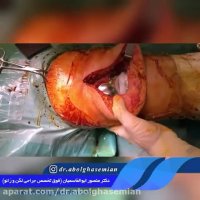 تعویض مفصل زانو