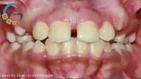 ارتودنسی ثابت بدون کشیدن دندان | دکتر مسعود داوودیان