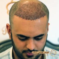 کاشت ابرو رنسانس - کلینیک تخصصی رنسانس
