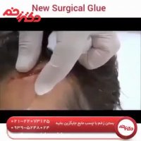 بستن زخم با چسب مایع