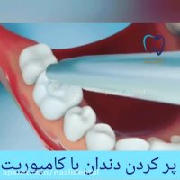 فیلم پر کردن دندان با کامپوزیت