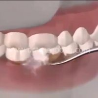 جرم گیری دندان