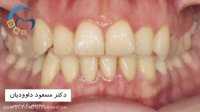 قبل و بعد ارتودنسی بدون کشیدن دندان | دکتر داوودیان