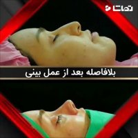 فیلم بلافاصله بعد از عمل بینی