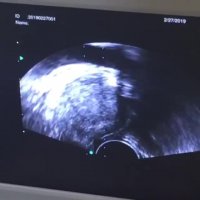 نمونه برداری پروستات (قسمت چهارم)