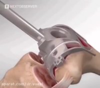 جراحی تعویض مفصل زانو