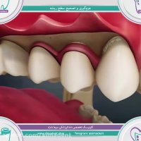جرمگیری و تصحیح سطح ریشه دندان | دندانپزشکی سیمادنت