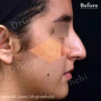 فیم عمل جراحی زیبایی بینی