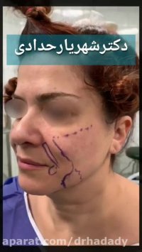 جراحی لیفت صورت