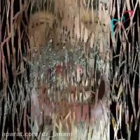 ایمپلنت فول فک پایین