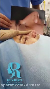 عمل بینی استخوانی مردانه