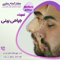 عمل بینی در مردان