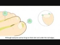 مبارزه با قارچ پا