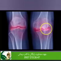 درمان قطعی روماتیسم مفصلی..