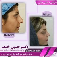 نمونه جراحی بینی دکتر حسین ختمی