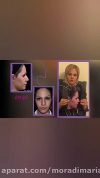 رضایت بیمار از جراحی بینی