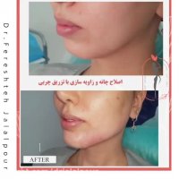 فیلم اصلاح چانه و زاویه سازی با تزریق چربی