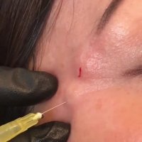 تزریق بوتاکس جهت رفع خطوط پنجه کلاغی کنار چشم | دکتر صفیه چعباوی زاده