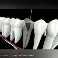 درمان ریشه به چه صورت انجام میشود؟