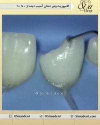 کامپوزیت ونیر | دندانپزشکی سیمادنت