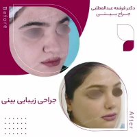 فیلم بعد از عمل بینی گوشتی از سه نما