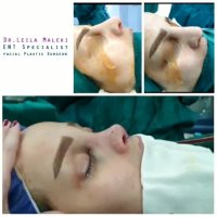 فیلم واقعی جراحی بینی