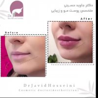 فیلم تزریق ژل لب طبیعی