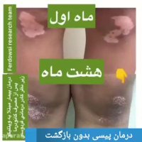 بیماری پیسی (ویتیلیگو) و بهترین روش درمانی کشف شده