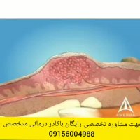 آیا فریز کردن درمان قطعی زگیل تناسلی است؟