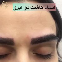کاشت ابرو طبیعی
