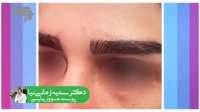 نمونه کاشت ابرو با تغییر مدل ابرو