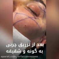 تزریق میکروچربی به شقیقه گونه و زاویه سازی