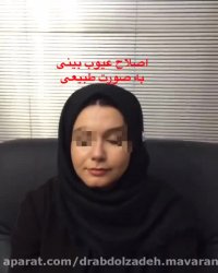 6 ماه بعد از جراحی بینی