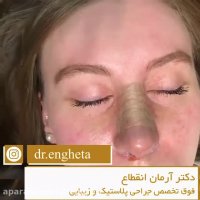 فیلم آموزش چسب زدن بینی بعد از عمل جراحی بینی