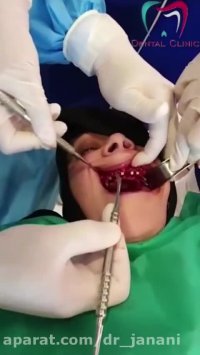 جراحی فول ایمپلنت در خانم ۶۵ ساله توسط دکتر شهریار جنانی