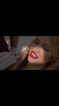 ونیر کامپوزیت فک بالا