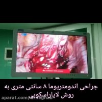 جراحی کیست با لاپاراسکوپی