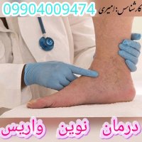 واریس چیست راههای پیشگیری و درمان این بیماری را بشناسیم.