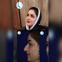 رضایت بیمار بیست روز بعد از جراحی بینی