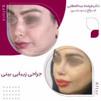 فیلم واقعی بعد از عمل بینی